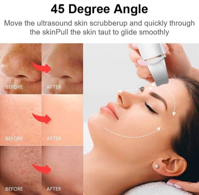 Ultrasonic Ion Skin Scrubber - Foreverfly