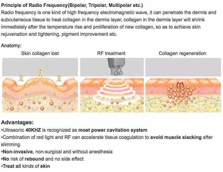 6 in 1 Cavitation Machine with 100mw Lipo Laser - Foreverfly
