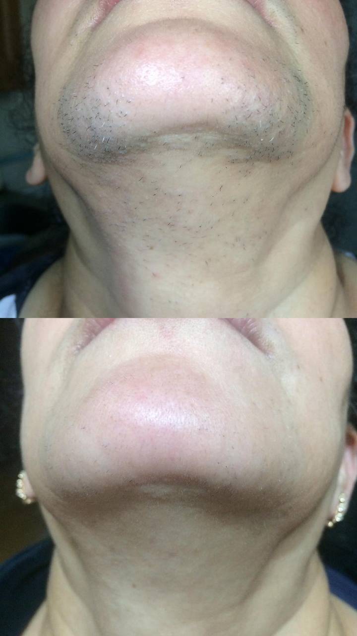 Elite-Smooth Hair Removal Diode Laser - Foreverfly