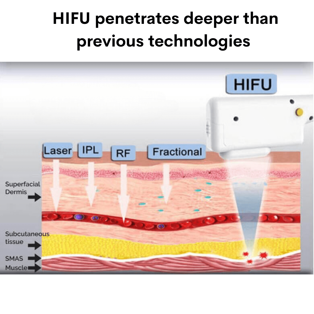 4D Face Lifting HIFU Machine - Foreverfly