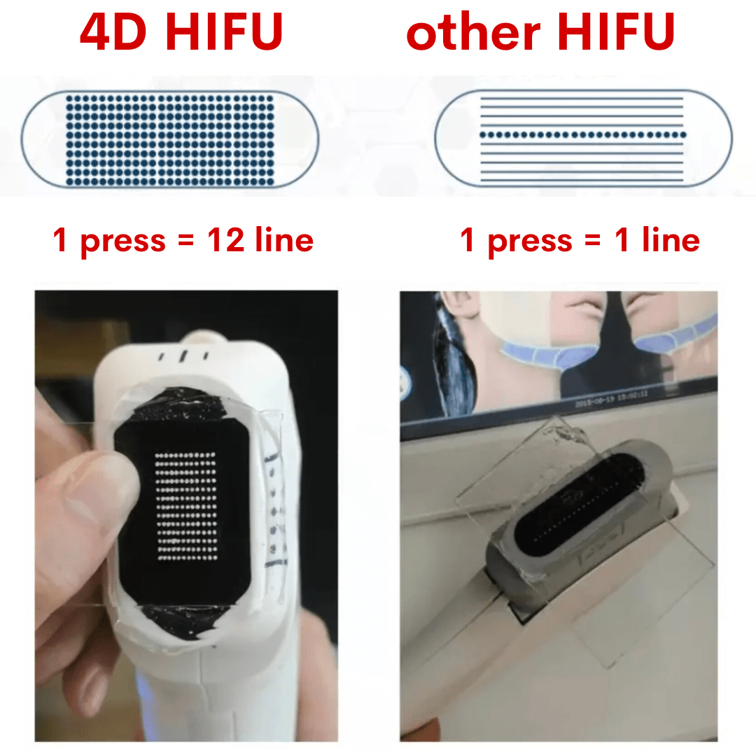 4D Face Lifting HIFU Machine - Foreverfly