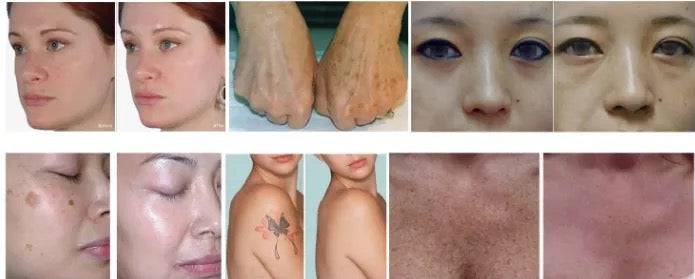 2023 Pico Laser Tattoo Removal Machine - Portable - Foreverfly