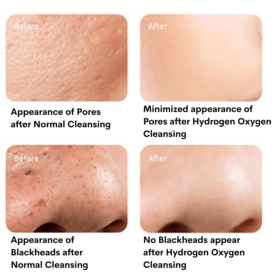 6 in 1 Professional Hydro Dermabrasion Machine - Foreverfly