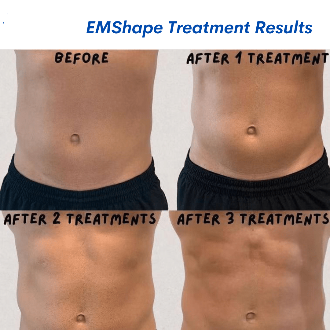EMShape Body Contouring Machine Android Pro - Foreverfly