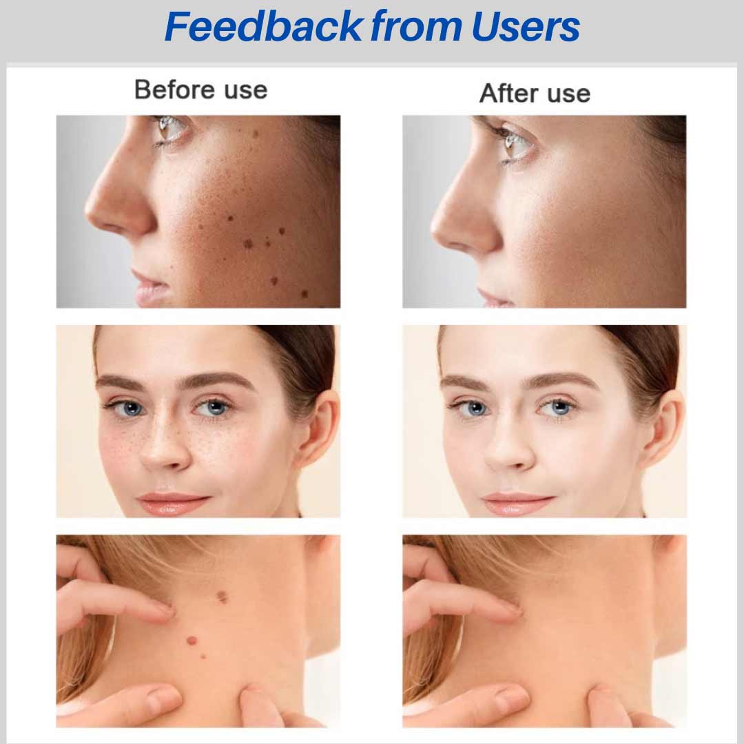 9 Levels Skin Tag Removal Kit - Foreverfly