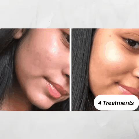 Microdermabrasion Skin Rejuvenation Kit - Foreverfly