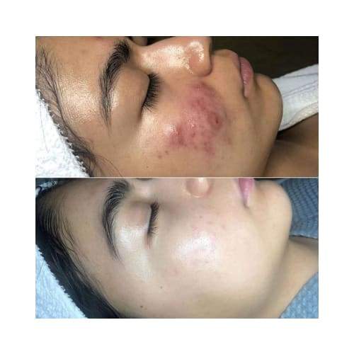 High Frequency Skin Rejuvenator - Foreverfly