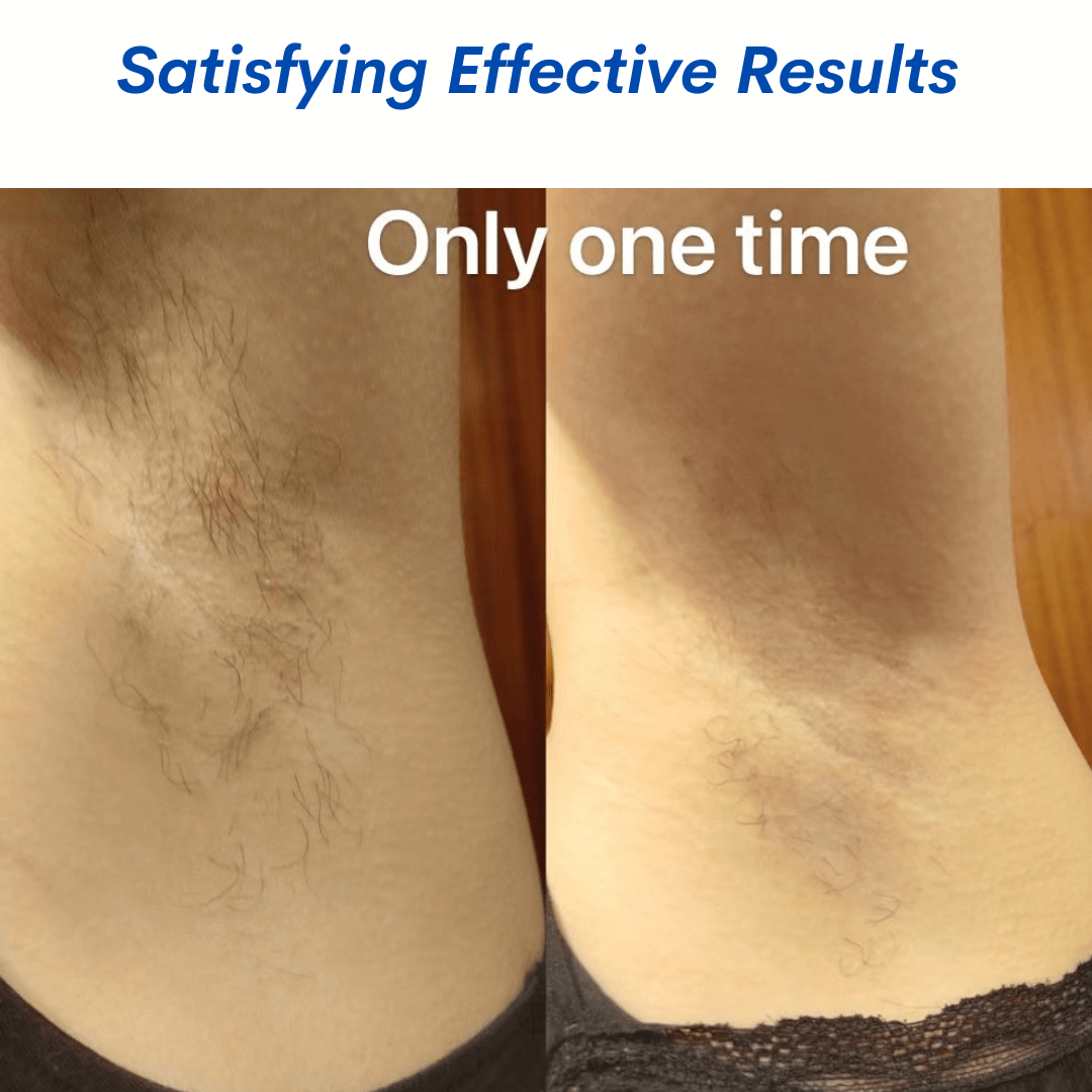 Elite-Smooth Hair Removal Diode Laser - Foreverfly 