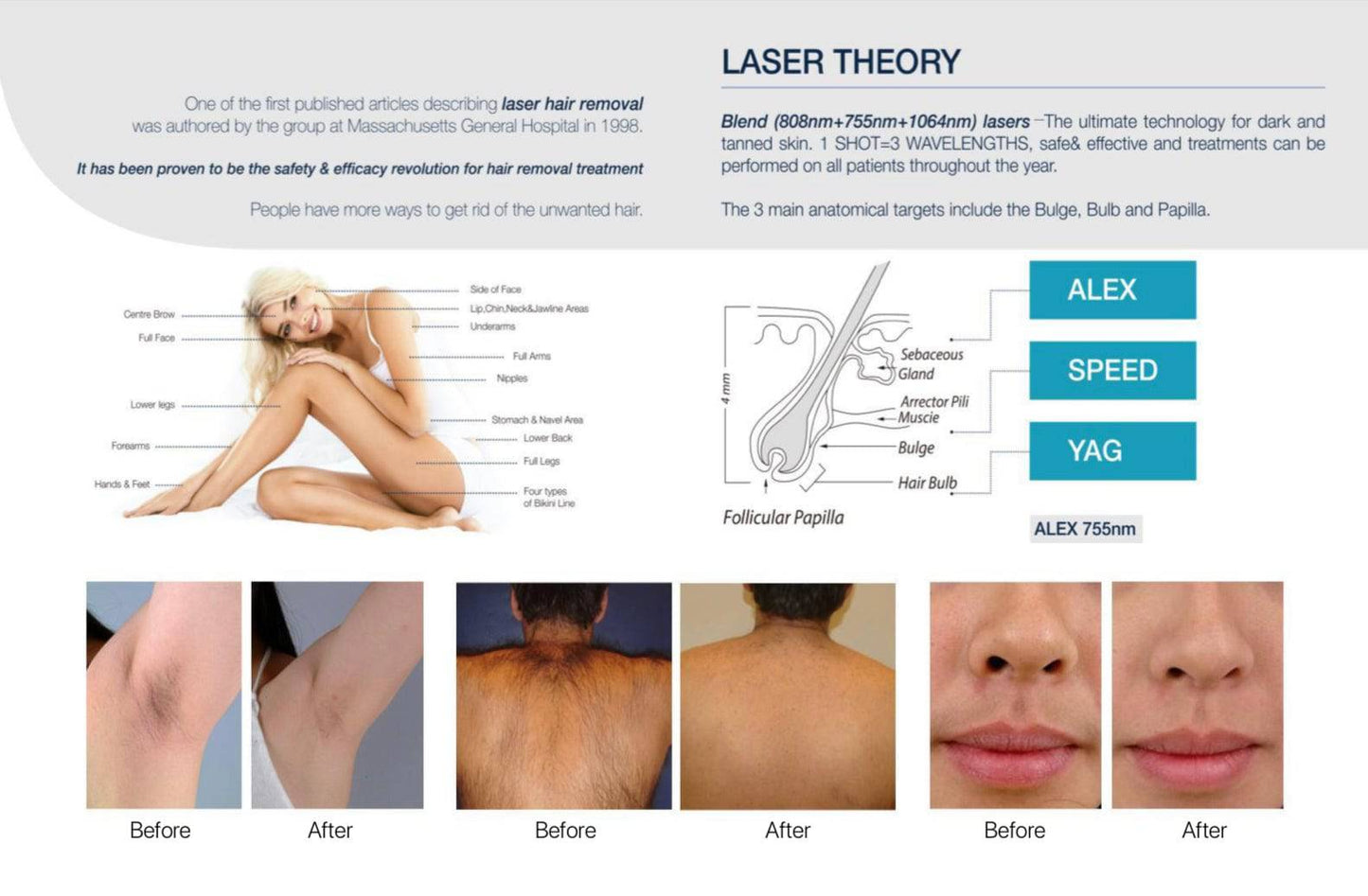 Elite-Smooth Hair Removal Diode Laser - Foreverfly 