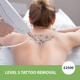 Level 5 Tattoo Removal - Foreverfly 