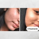 Microdermabrasion Skin Rejuvenation Kit - Foreverfly 